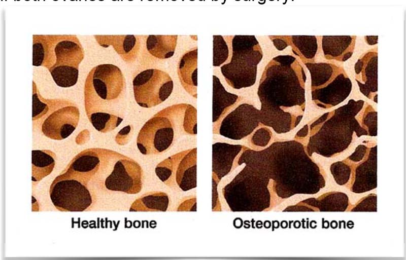 Dan's article bone pic